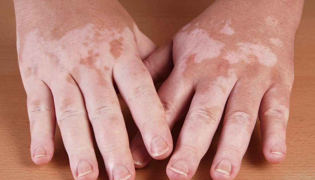 I risultati di questa revisione sistematica e meta-analisi suggeriscono che la fototerapia UV è un trattamento sicuro per la vitiligine senza un rischio significativo di cancro della pelle.